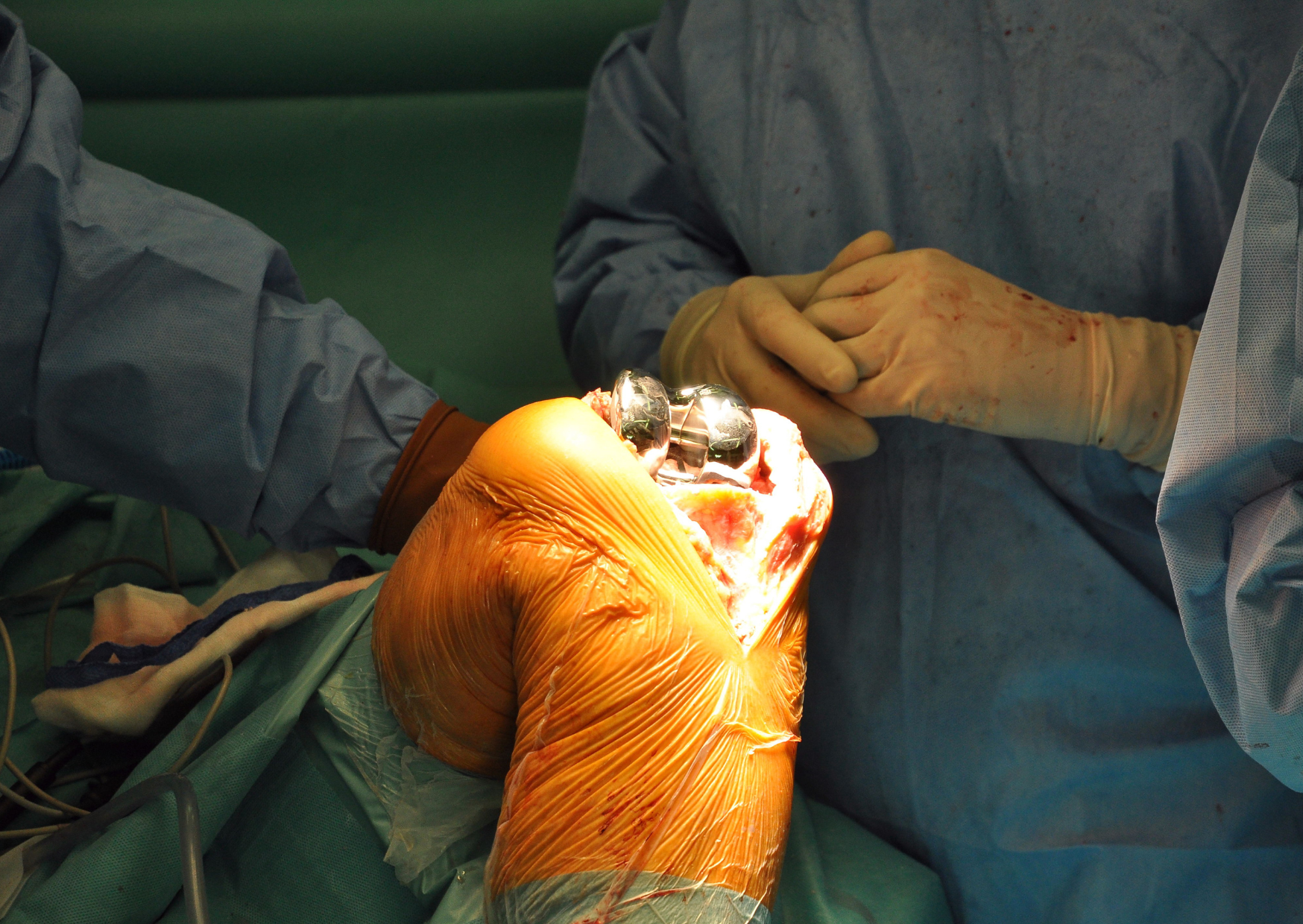 The Knee Replacement That Costs $50,000 in America and €6,000 in Spain 2 Knee Replacement 4